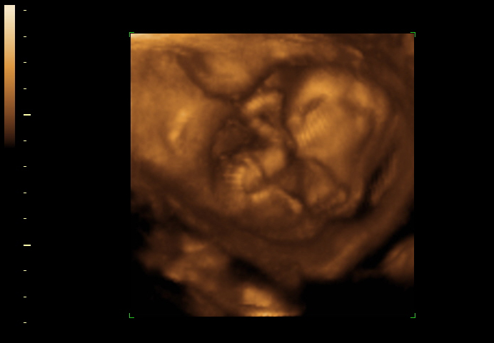 3D ultrasound image at 15 weeks